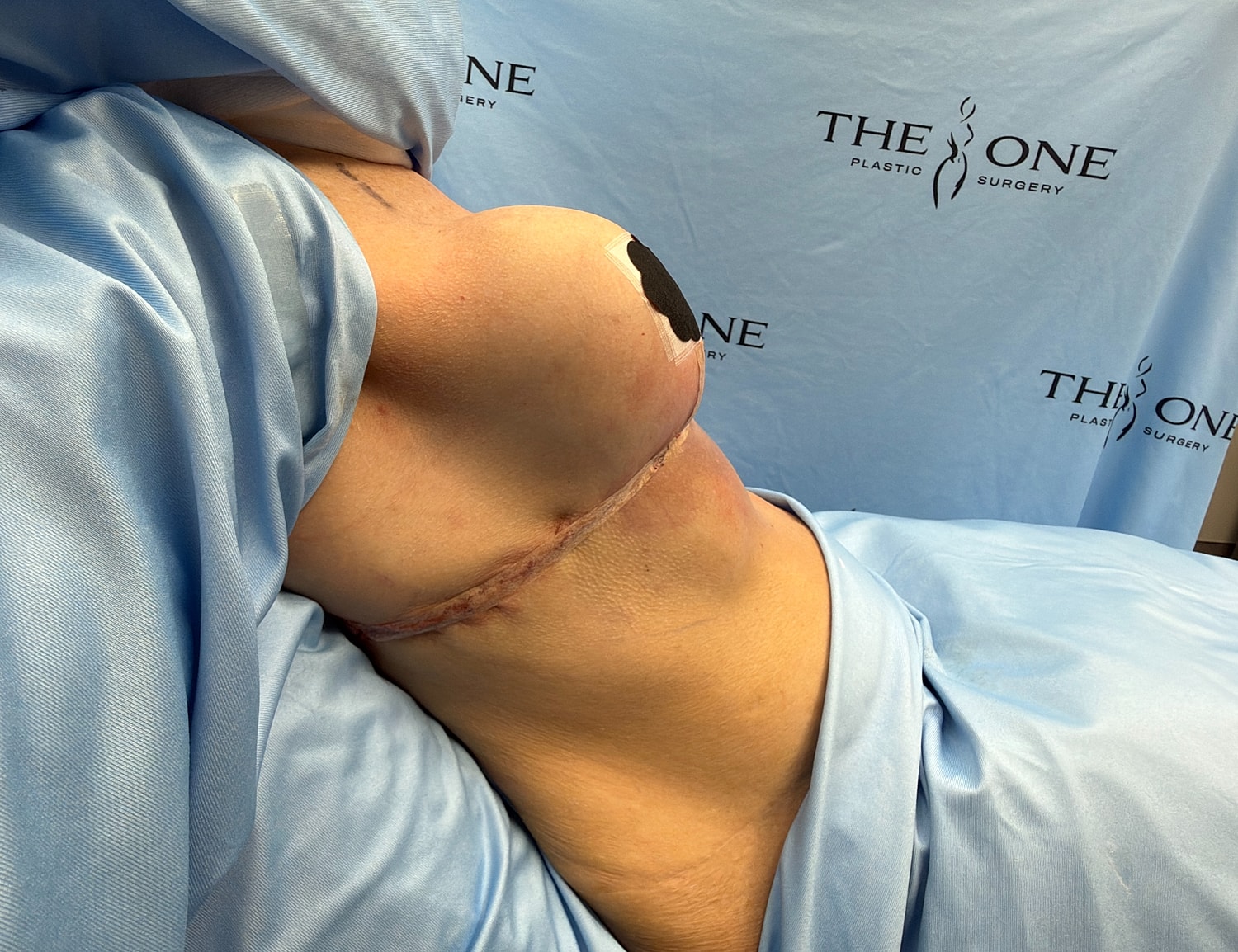 Post-surgery photo featuring breast augmentation procedure.