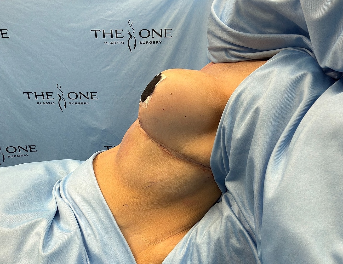 Medical procedure in a plastic surgery setting.
