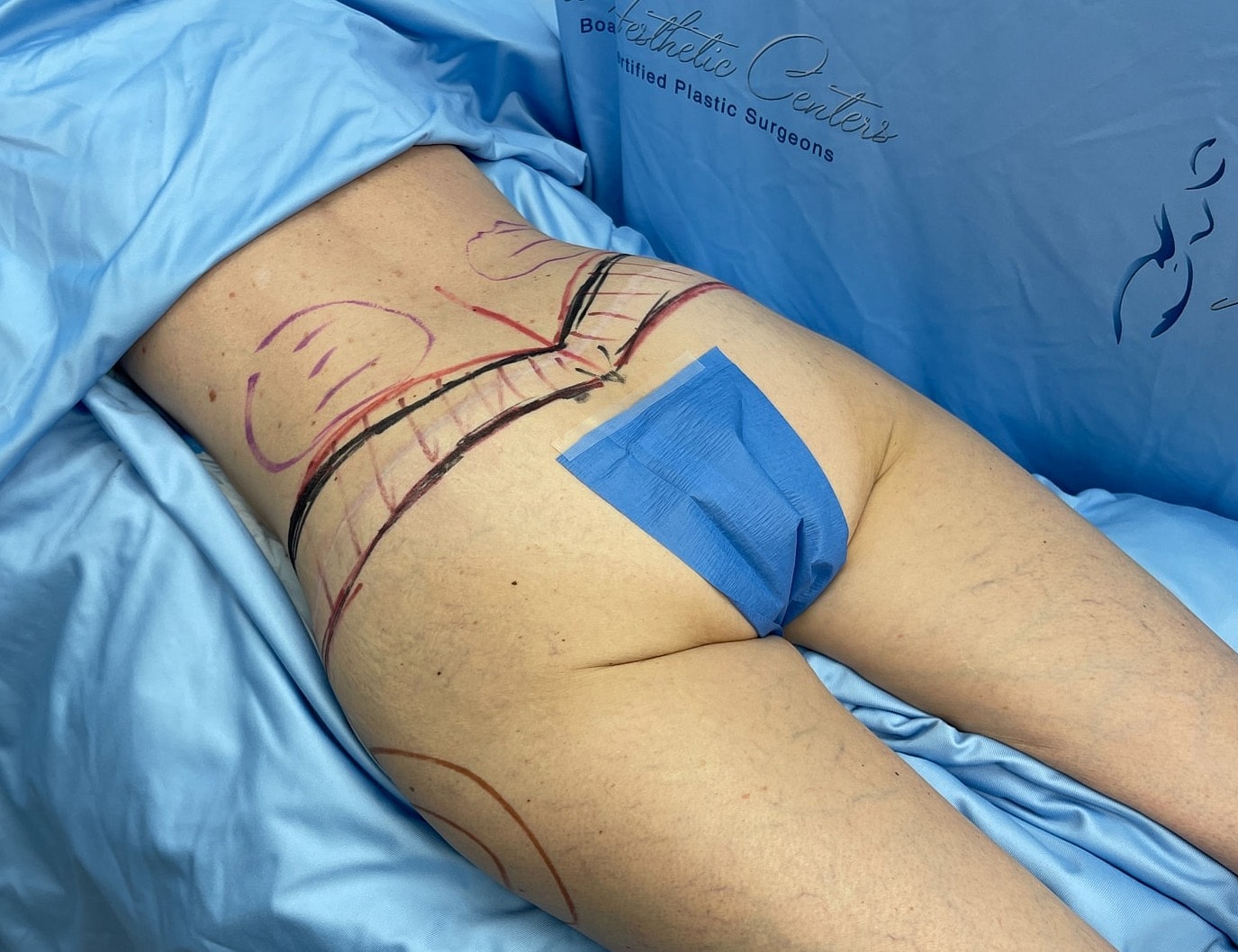 Body contouring markings on patient’s lower back.