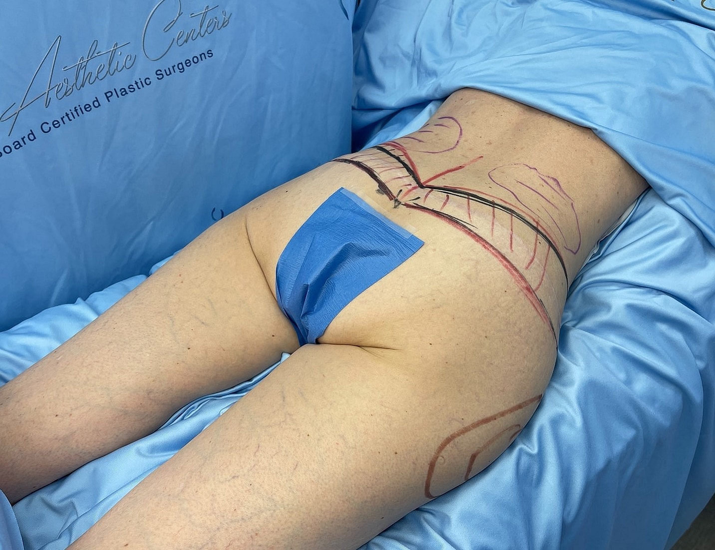 Patient preparation for body contouring procedure.