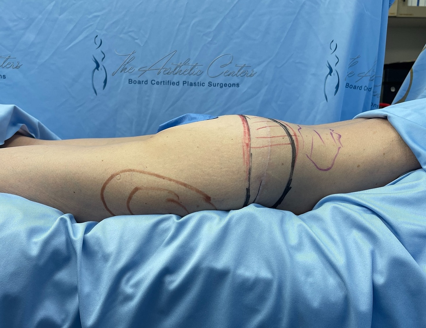 Patient leg prepared for plastic surgery procedure.