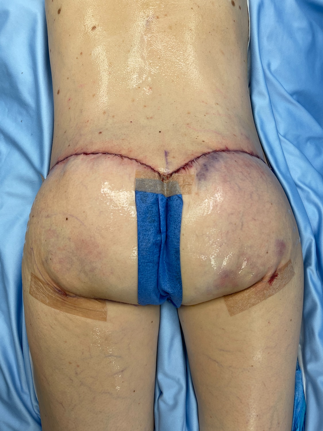 Post-surgery recovery of lower back area.