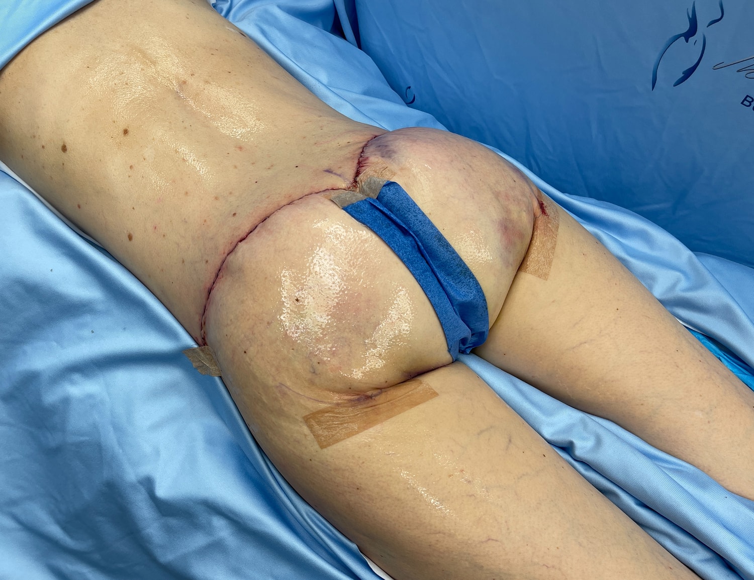 Post-surgical knee area with dressings and sutures.