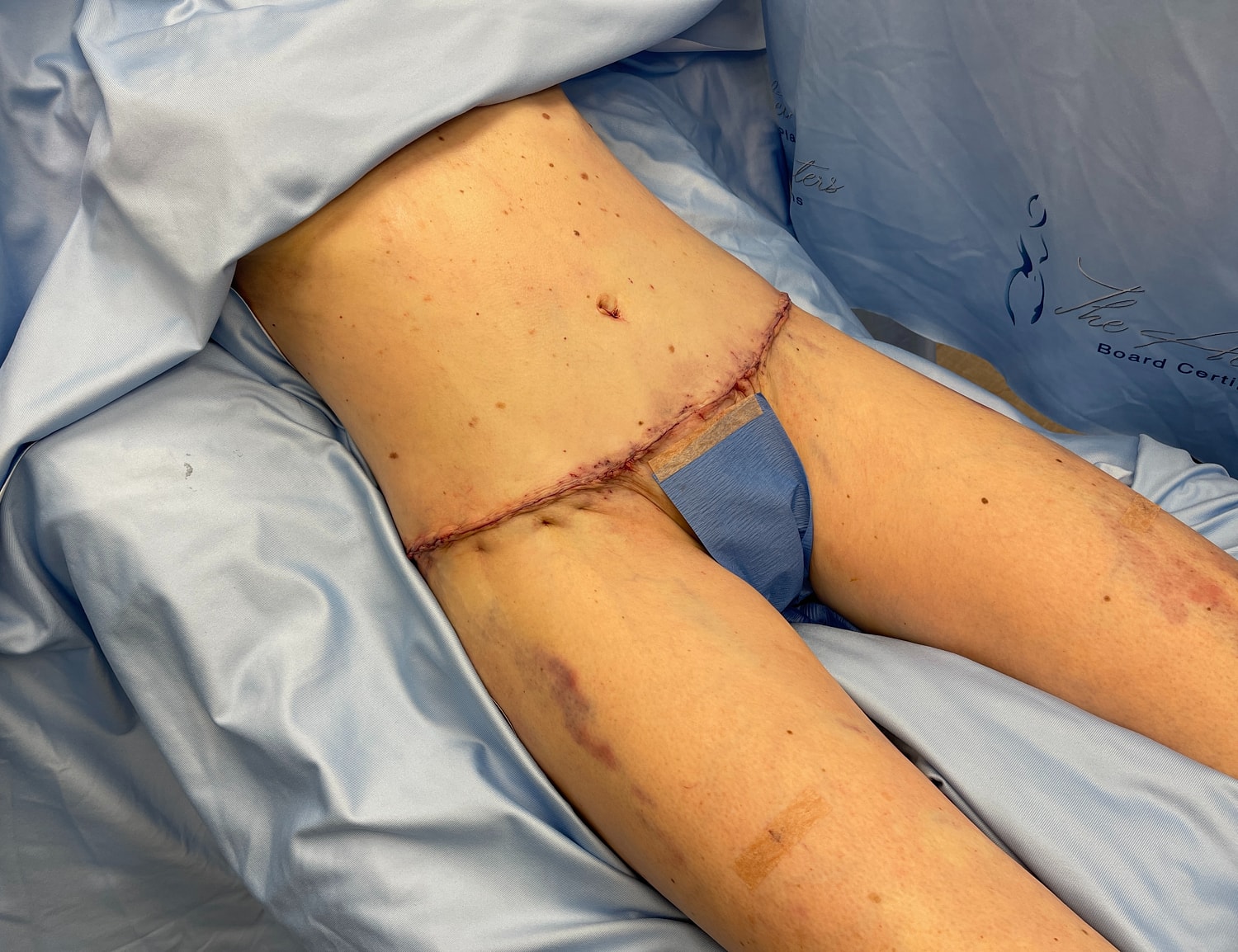 Post-surgical abdomen with stitches and bruising.
