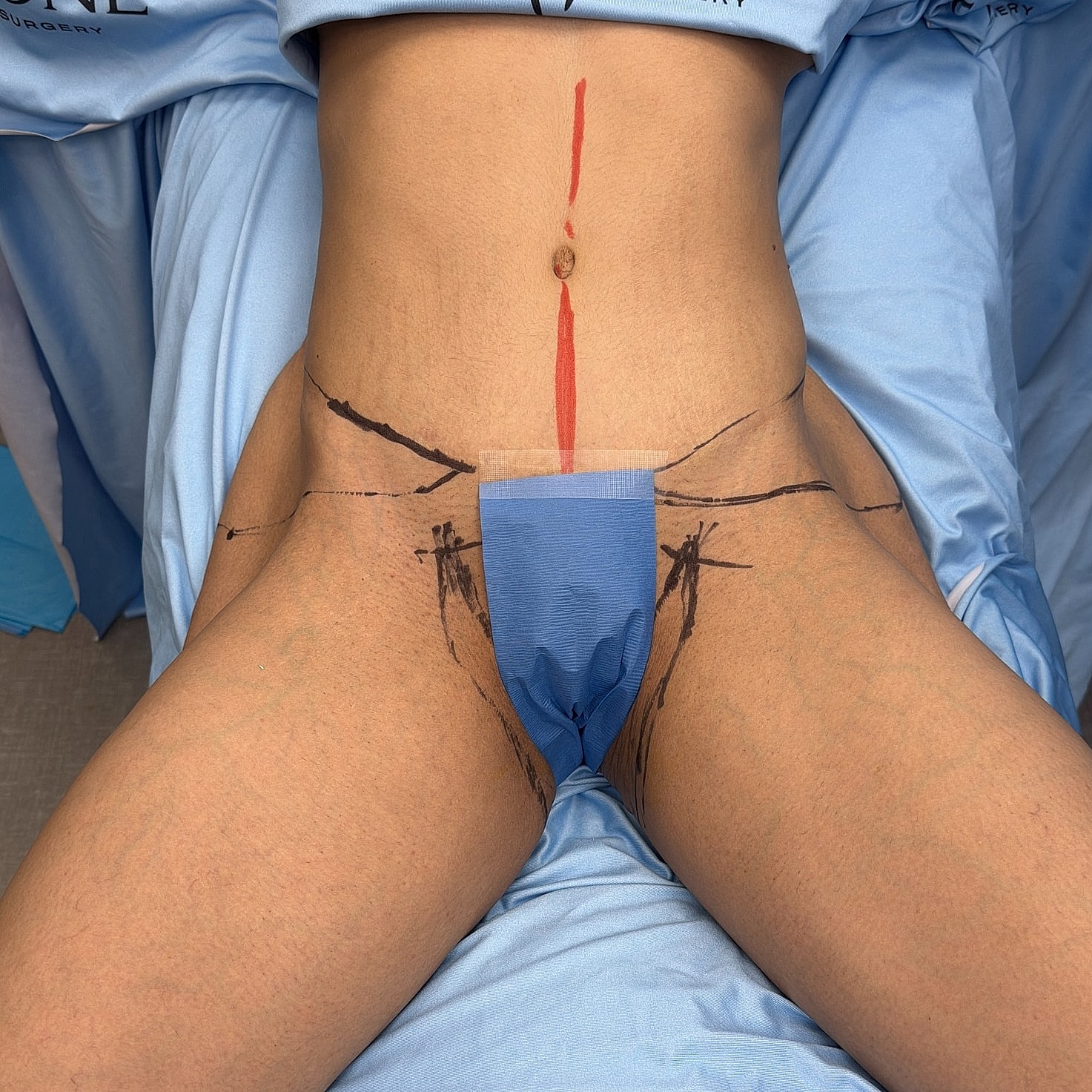 Surgical markings on patient abdomen for procedure.