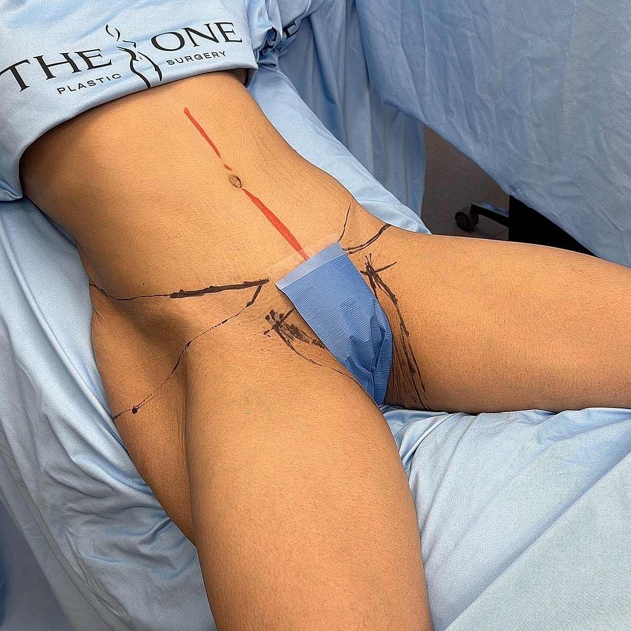Surgical markings on patient's abdomen and thigh area.