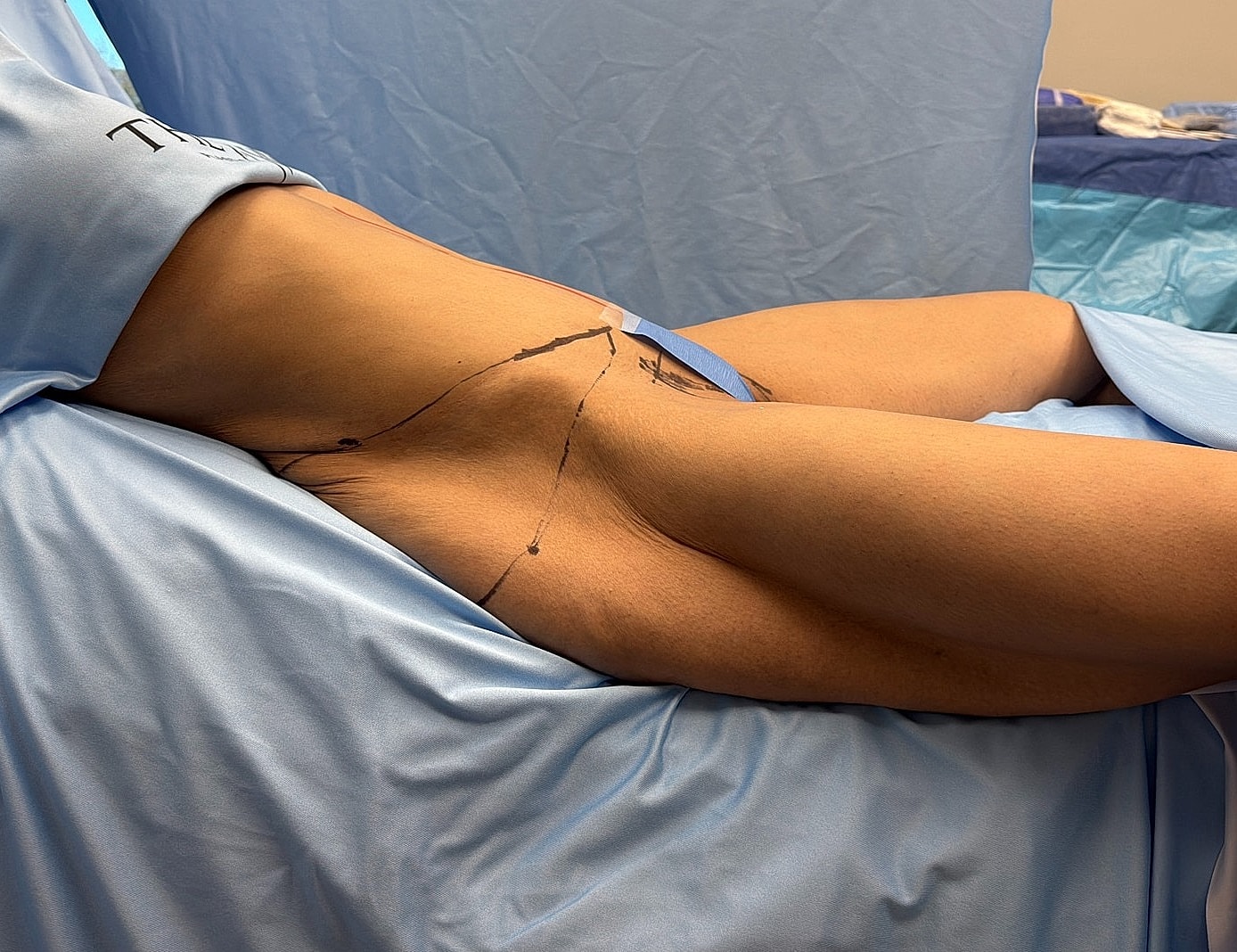 Patient with marked surgical area on thigh.