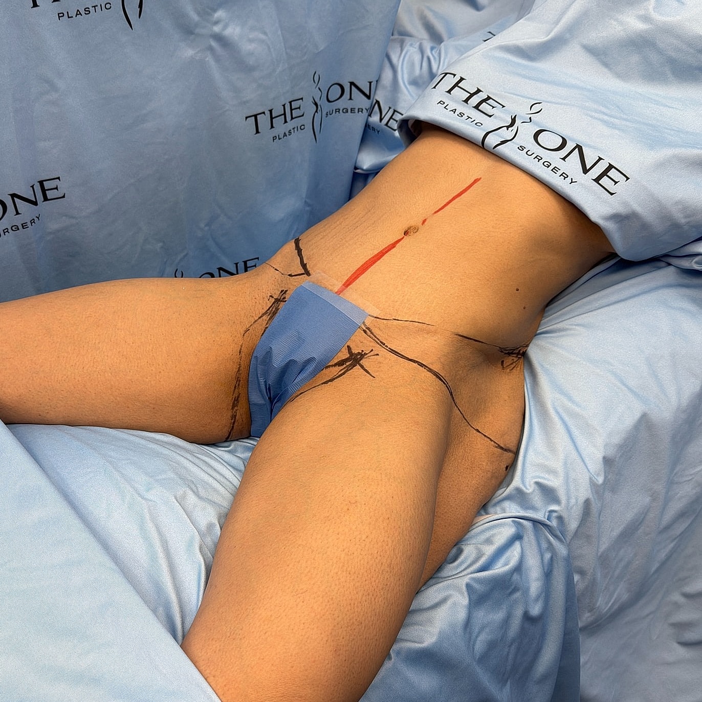 Plastic surgery preparation with markings and draping.