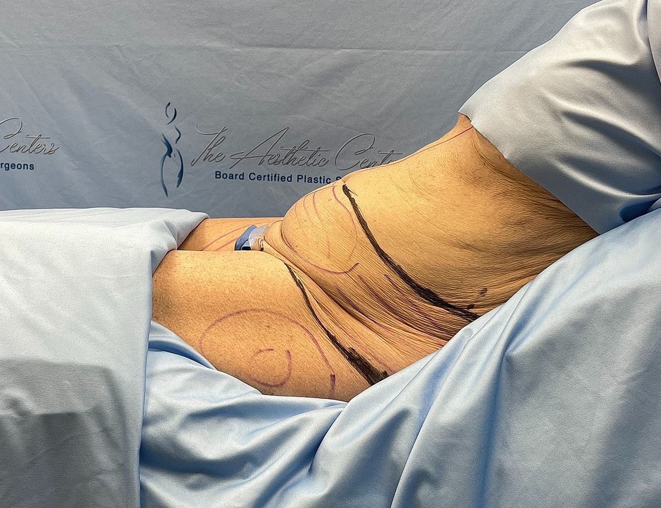 Patient preparation for plastic surgery procedure.