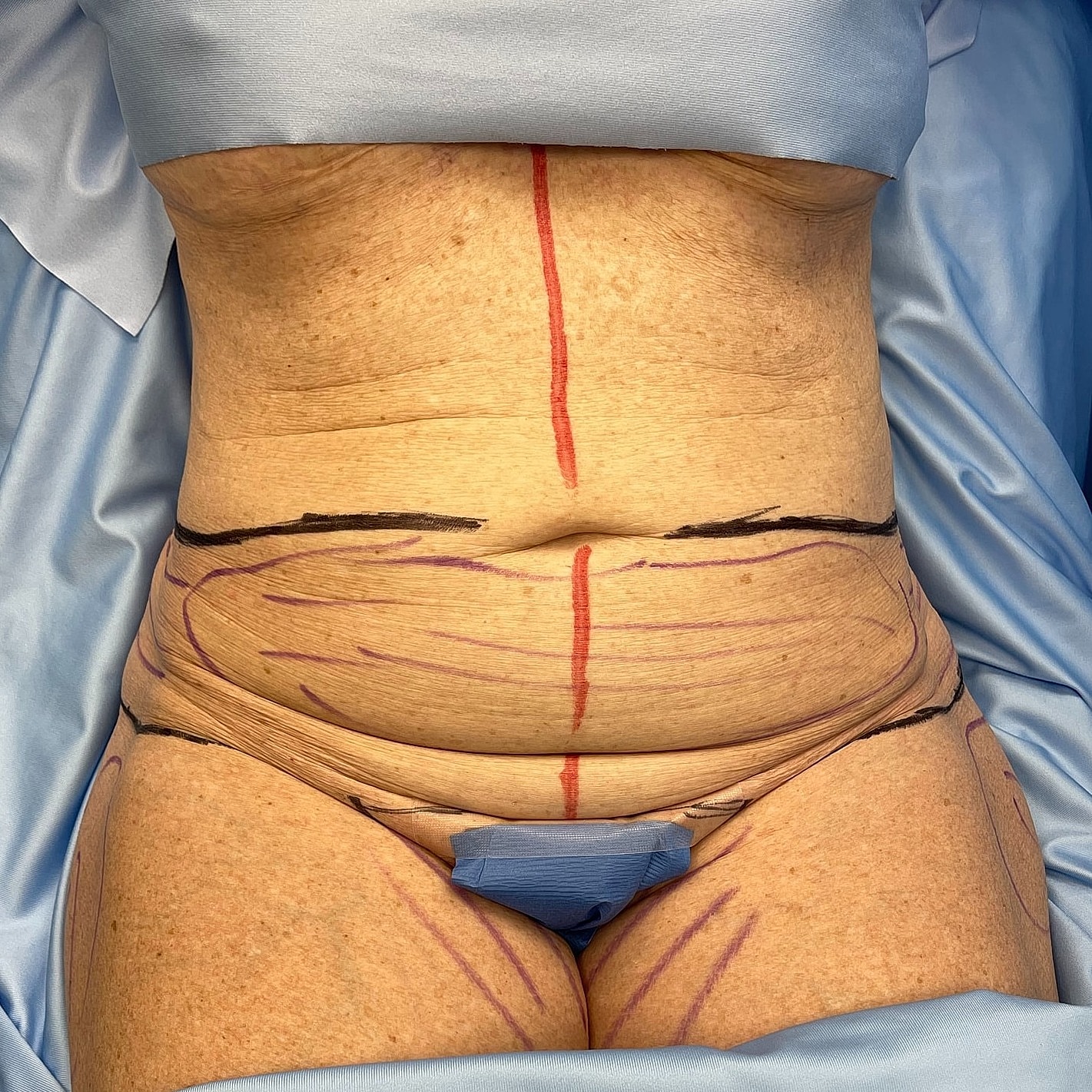Labeled abdomen pre-surgery for body contouring.