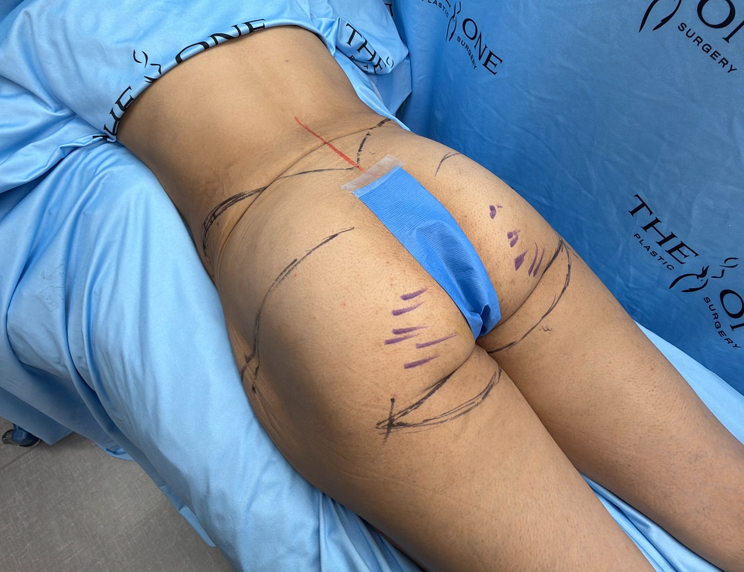Body contouring markings on a patient.