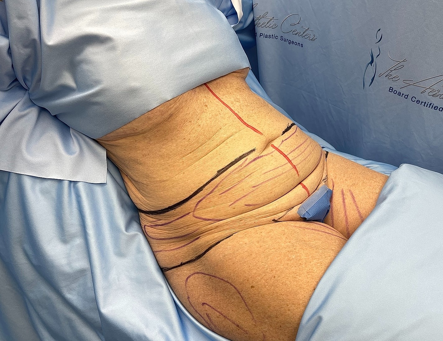 Marked body for surgical procedure preparation.