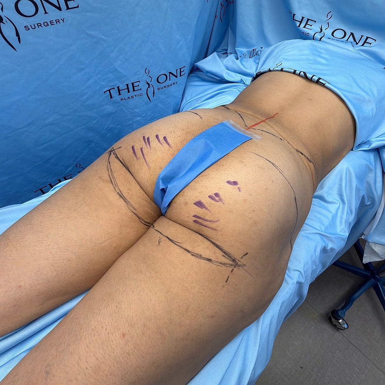 Surgical markings on a patient's body.