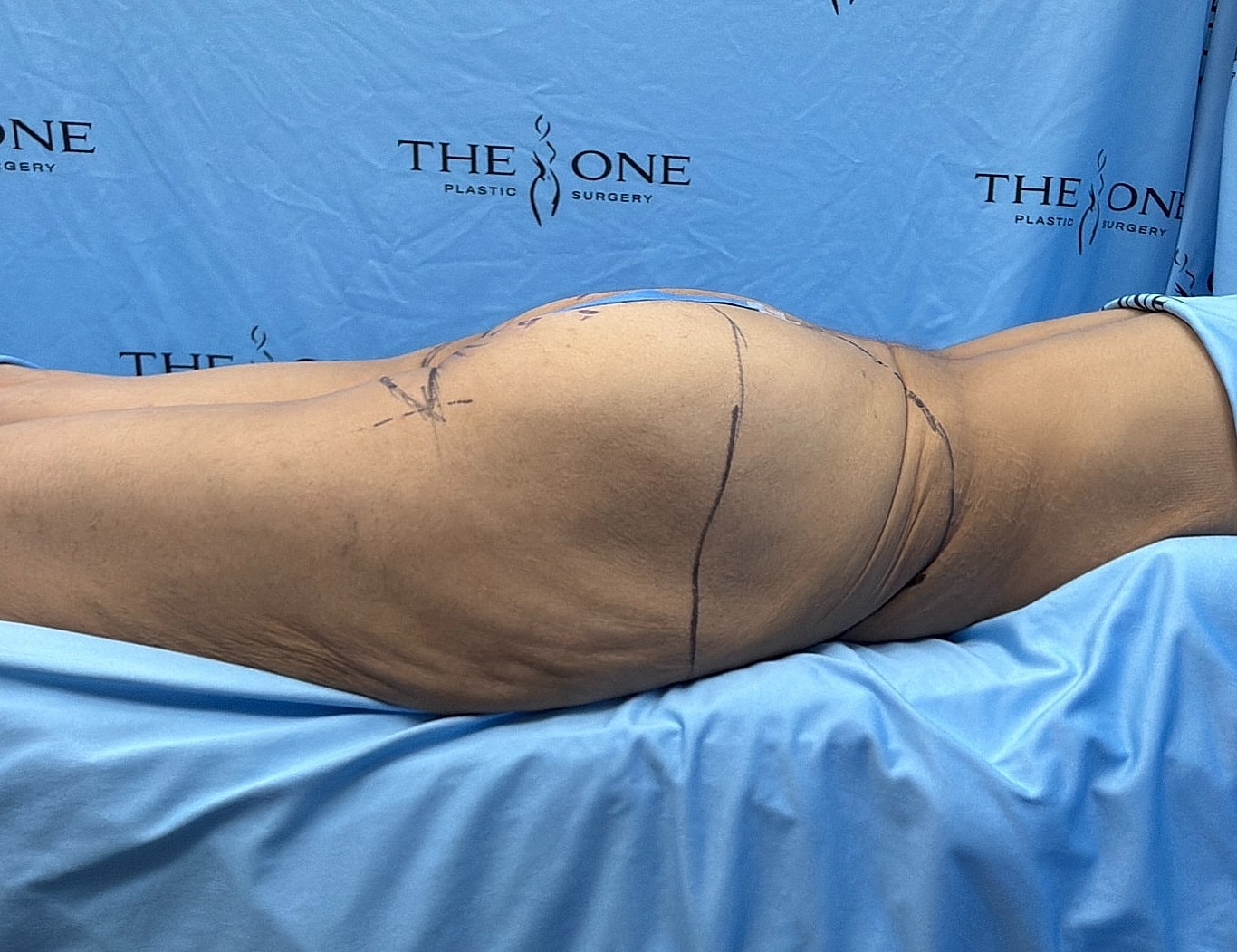 Patient preparation for plastic surgery procedure.