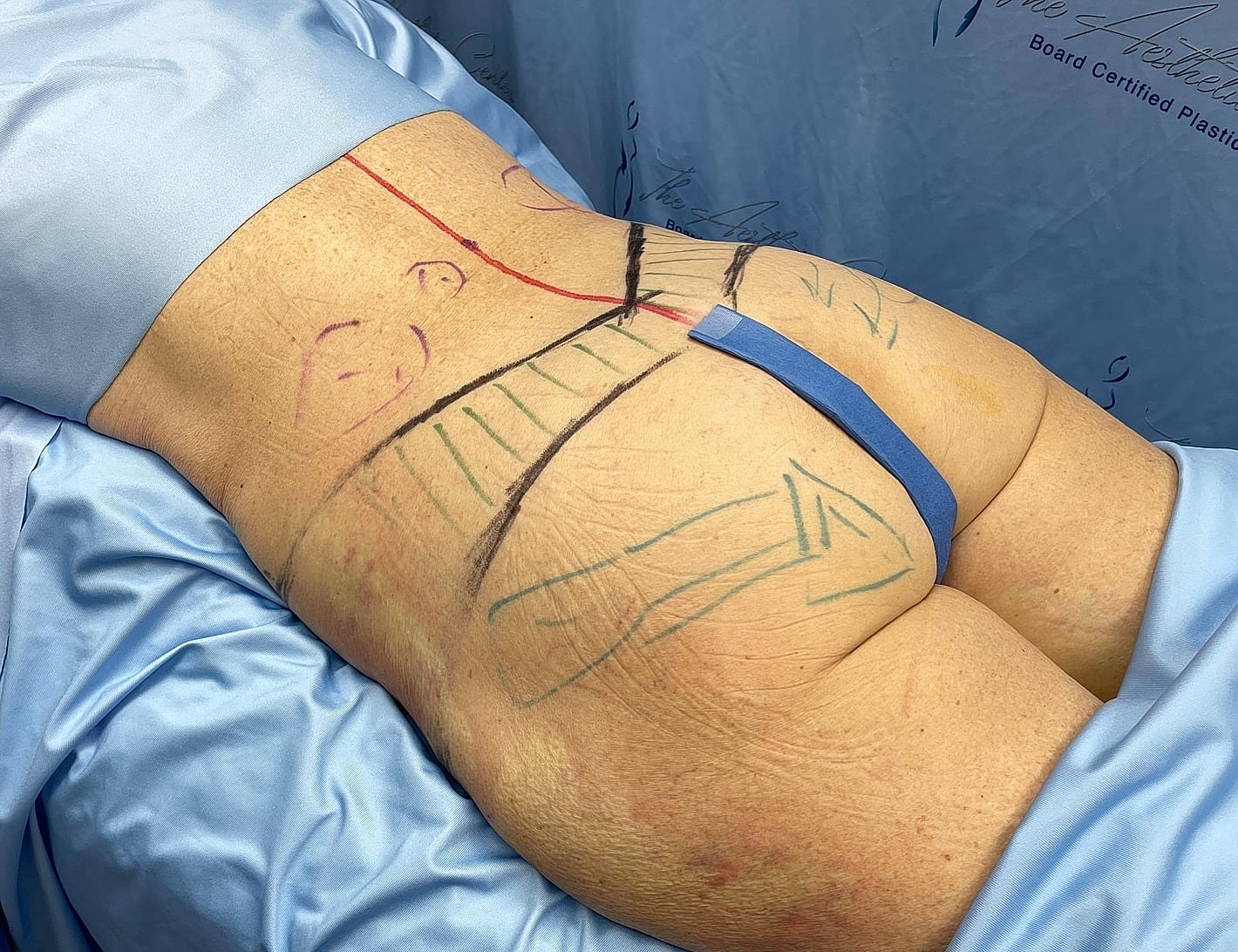 Patient preparation for body contouring procedure.
