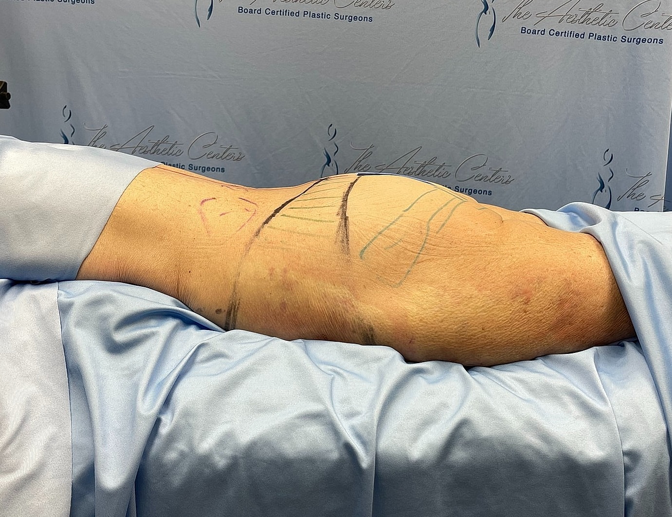 Patient's arm marked for plastic surgery procedure.