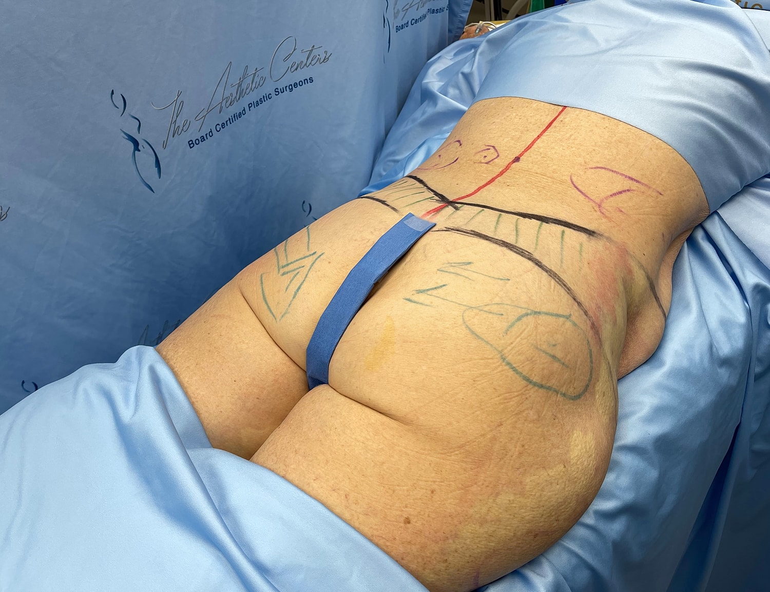 Surgical preparation on a patient's lower back.