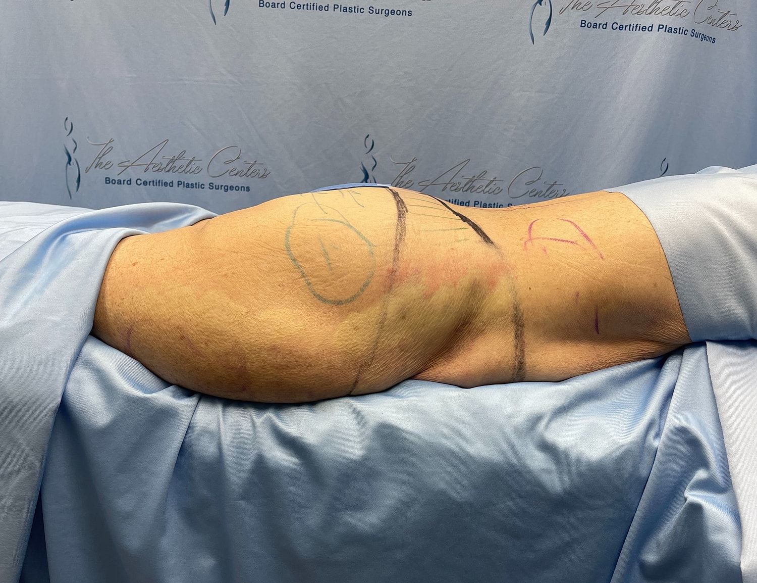 Patient's arm with markings for surgery preparation.