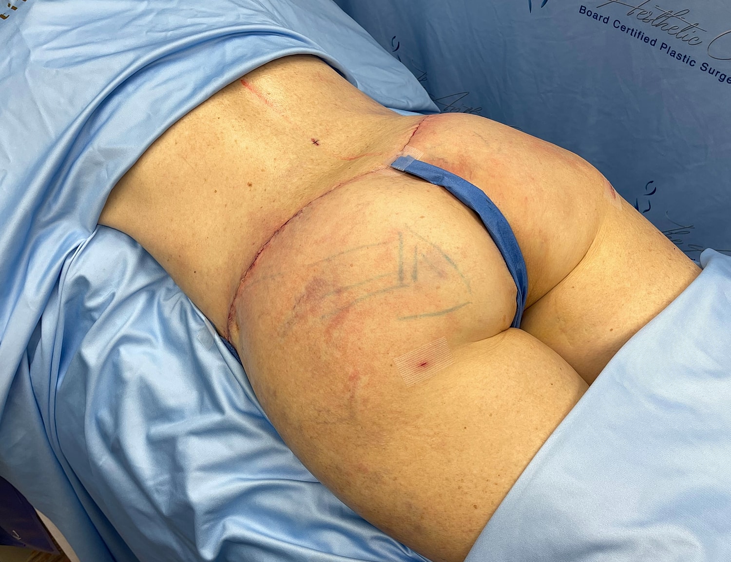 Surgical site on patient’s lower back and buttocks.