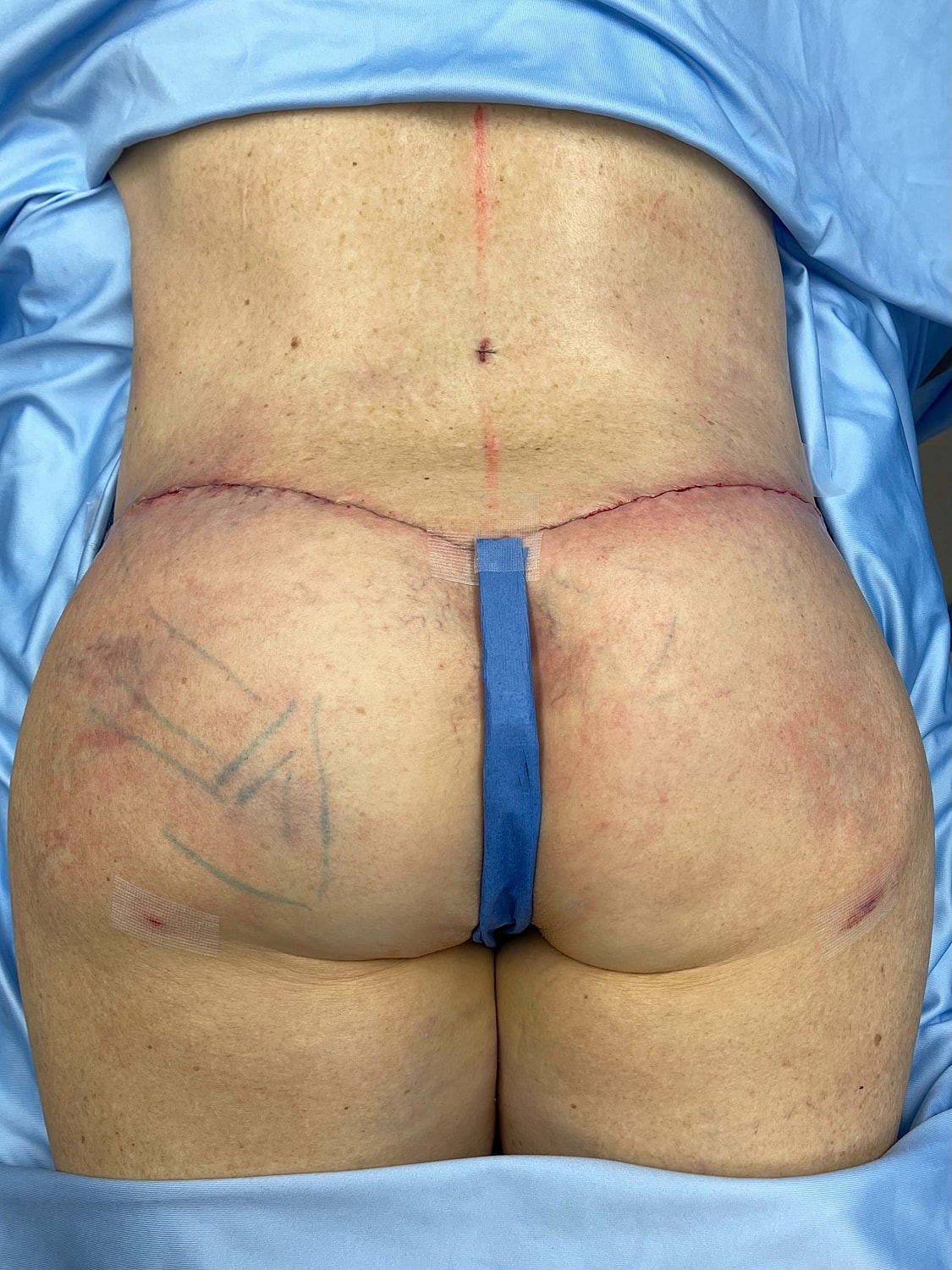 Post-surgery view of a lower back and buttocks.