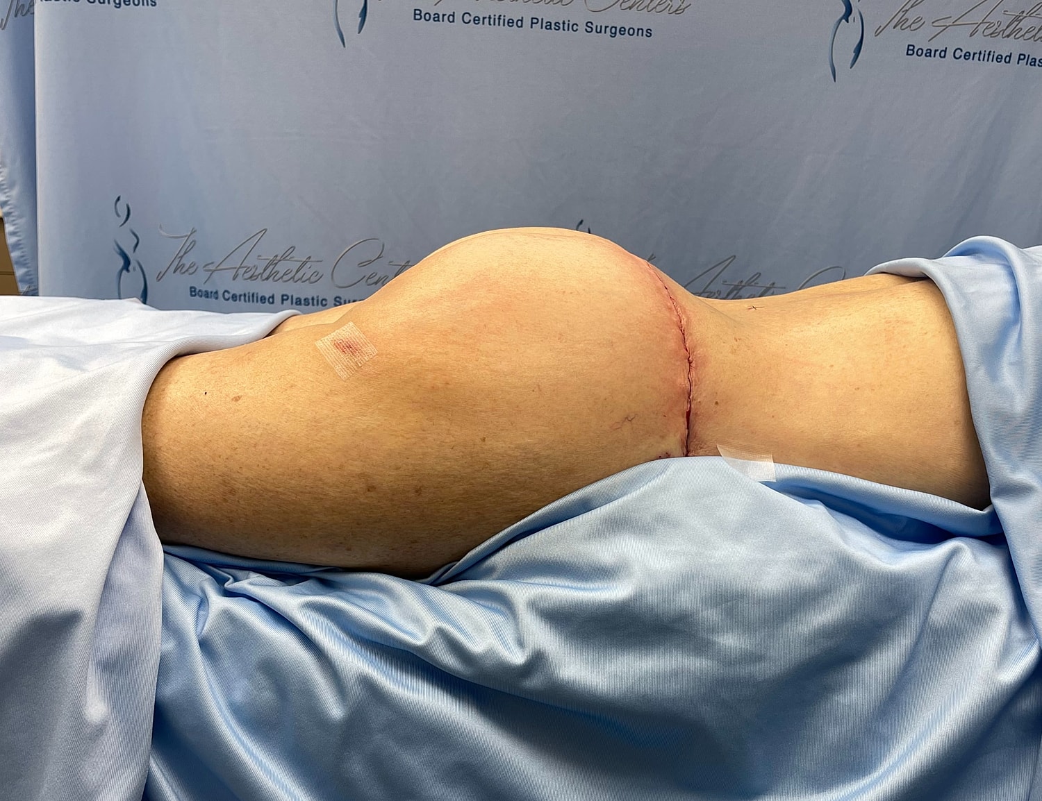 Post-surgery image of a body contouring procedure.