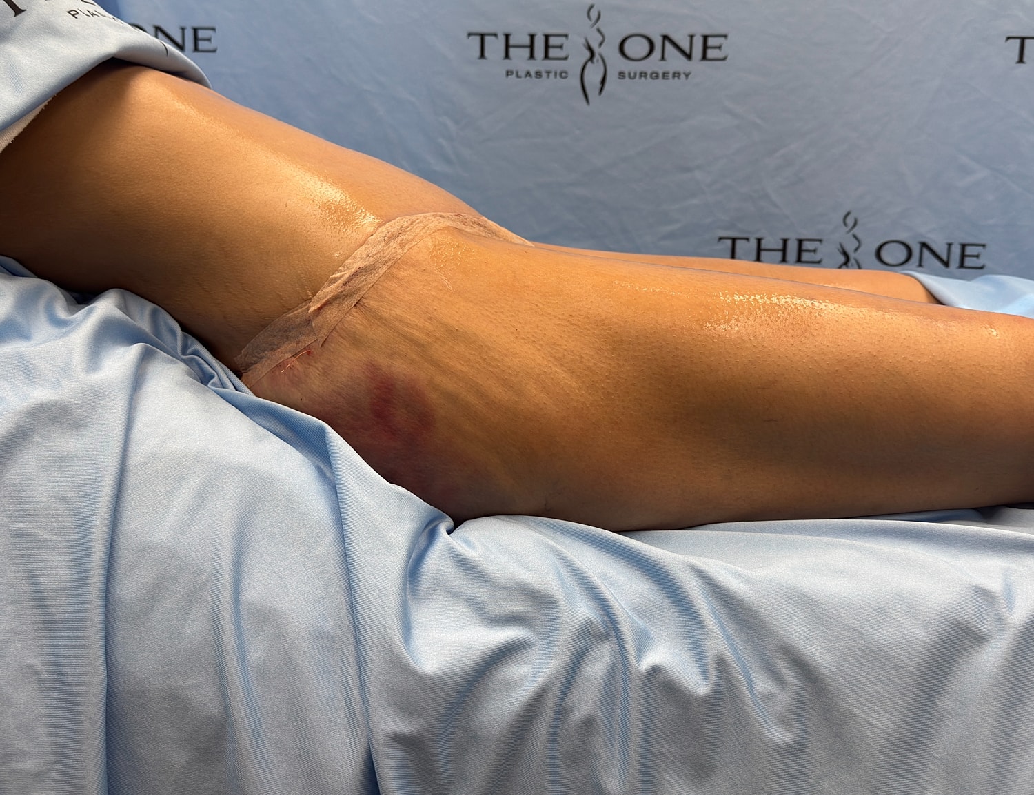 Post-surgery leg with bandage and swelling.