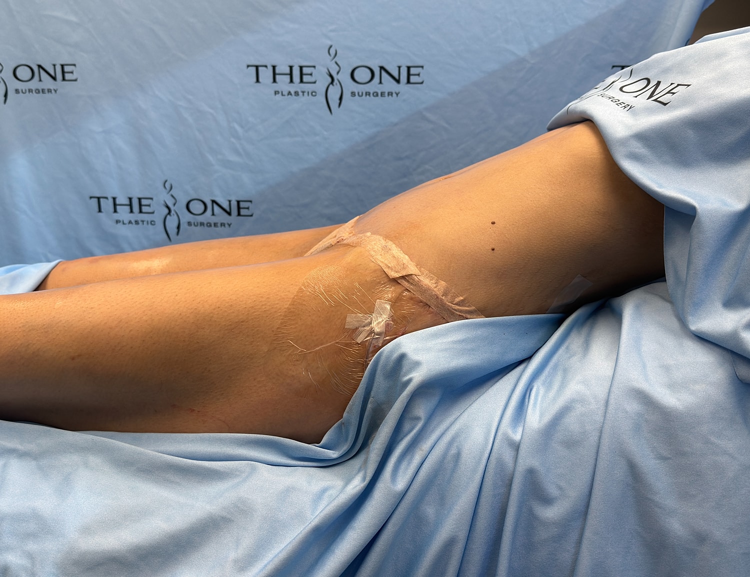 Patient's leg with surgical dressings post-procedure