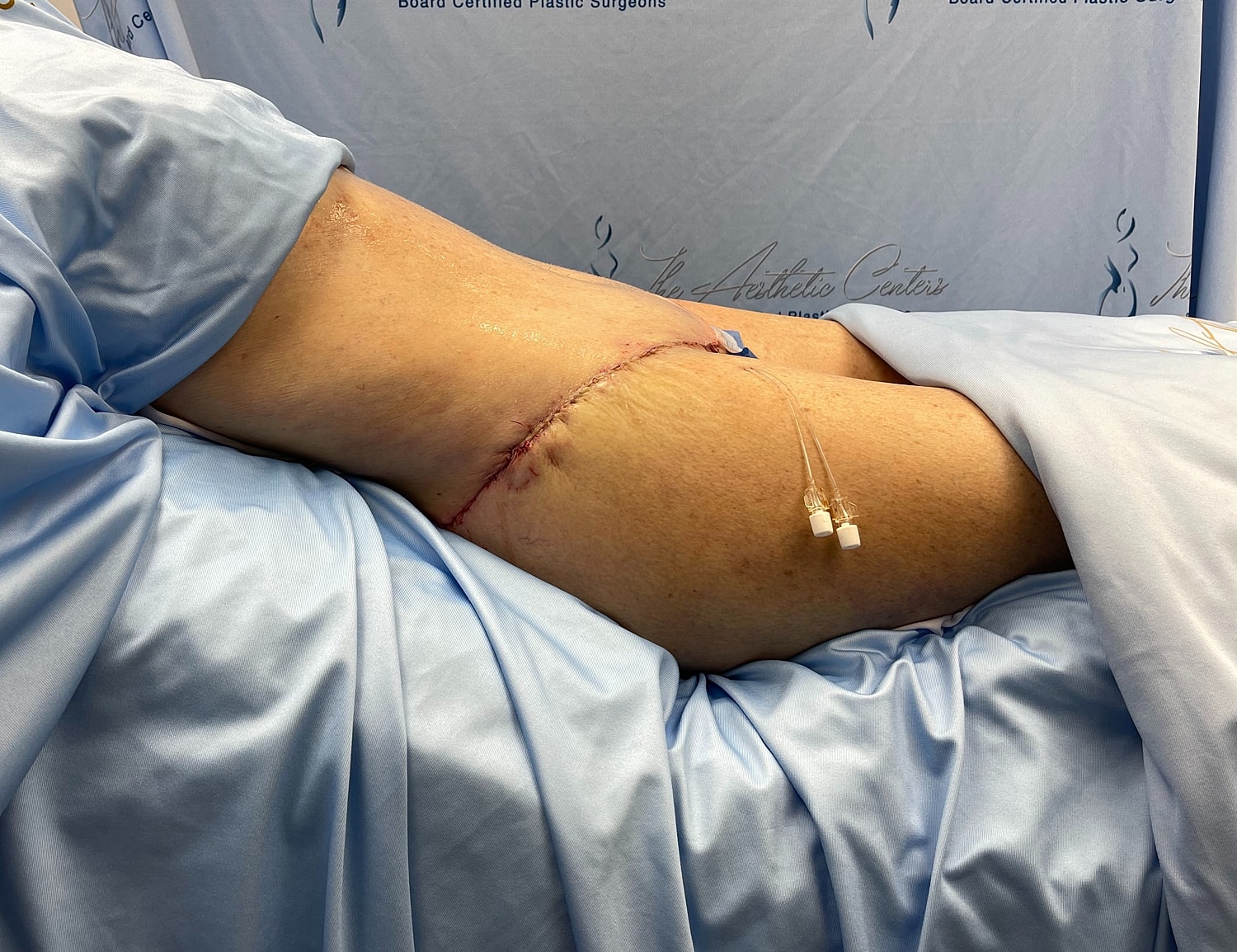 Surgical site on patient's thigh with visible incision.