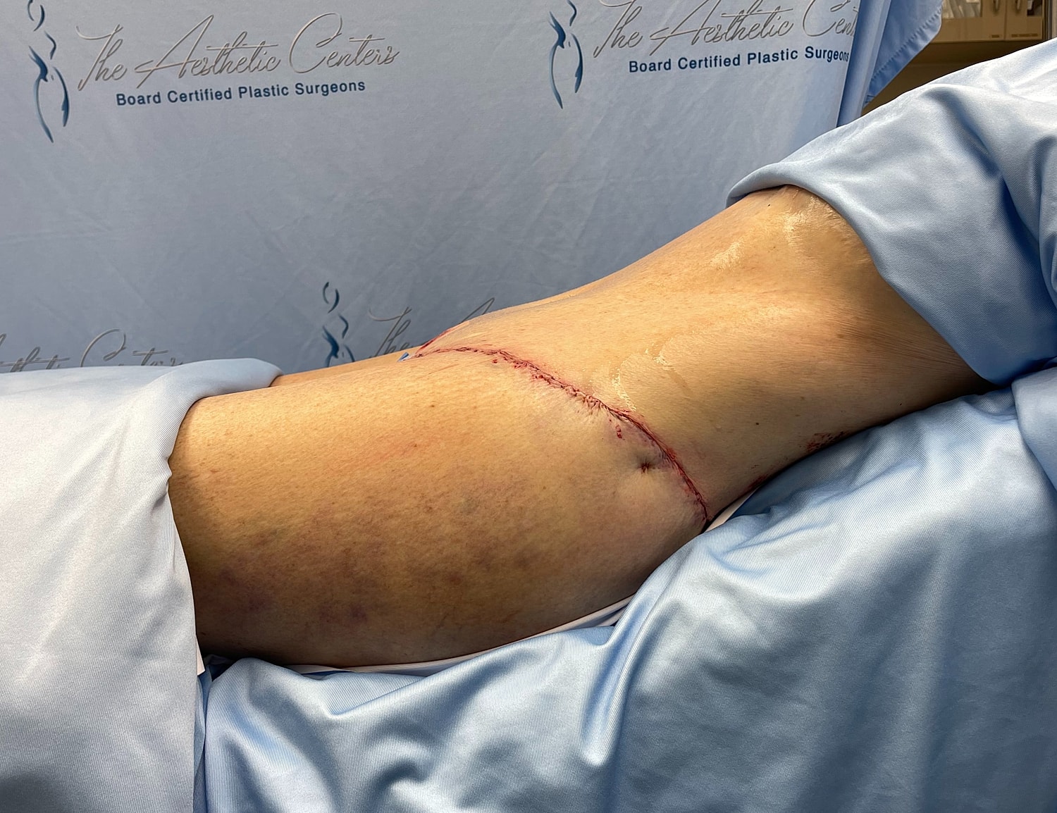 Surgical incision on patient’s leg.