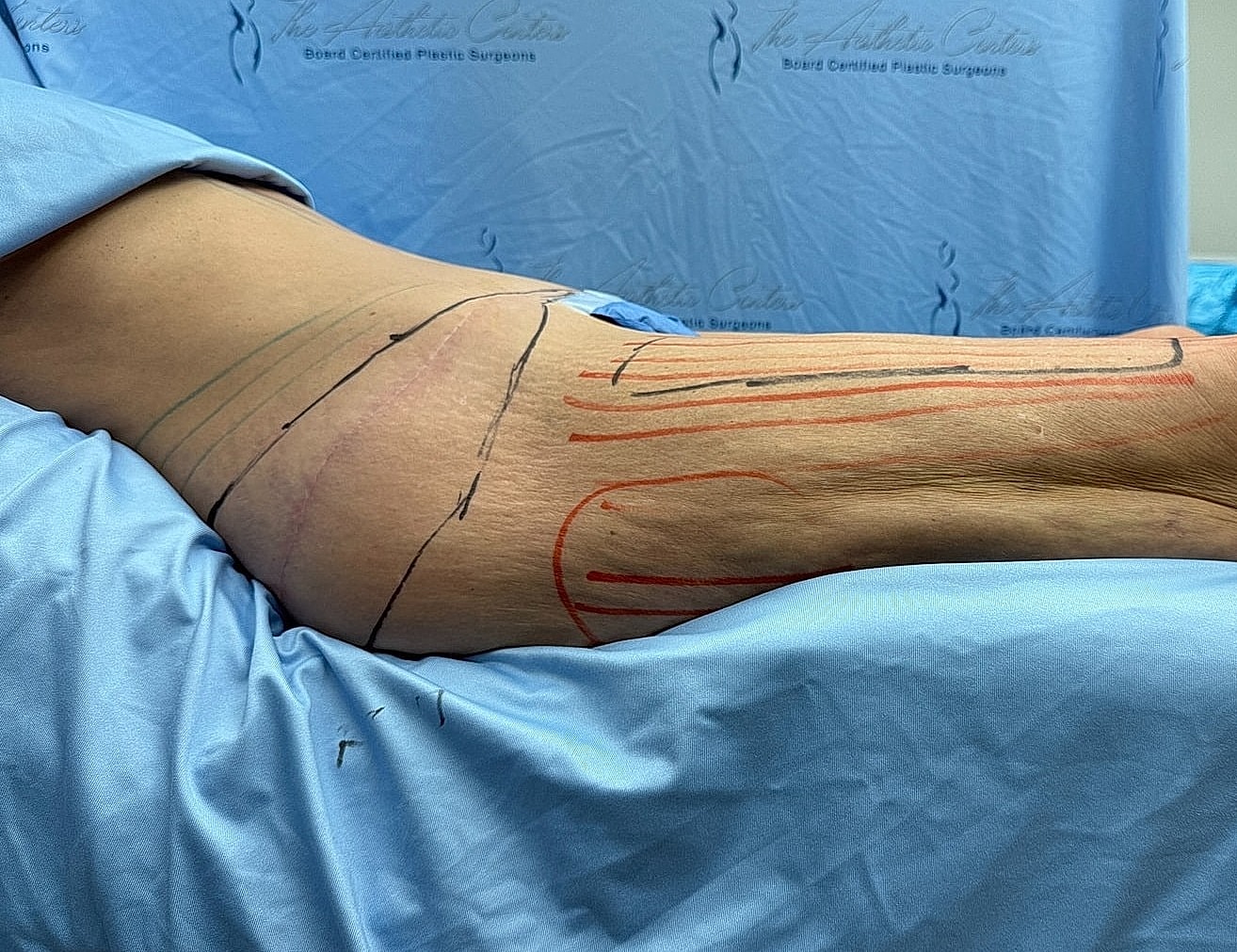 Marked skin preparation for surgical procedure.