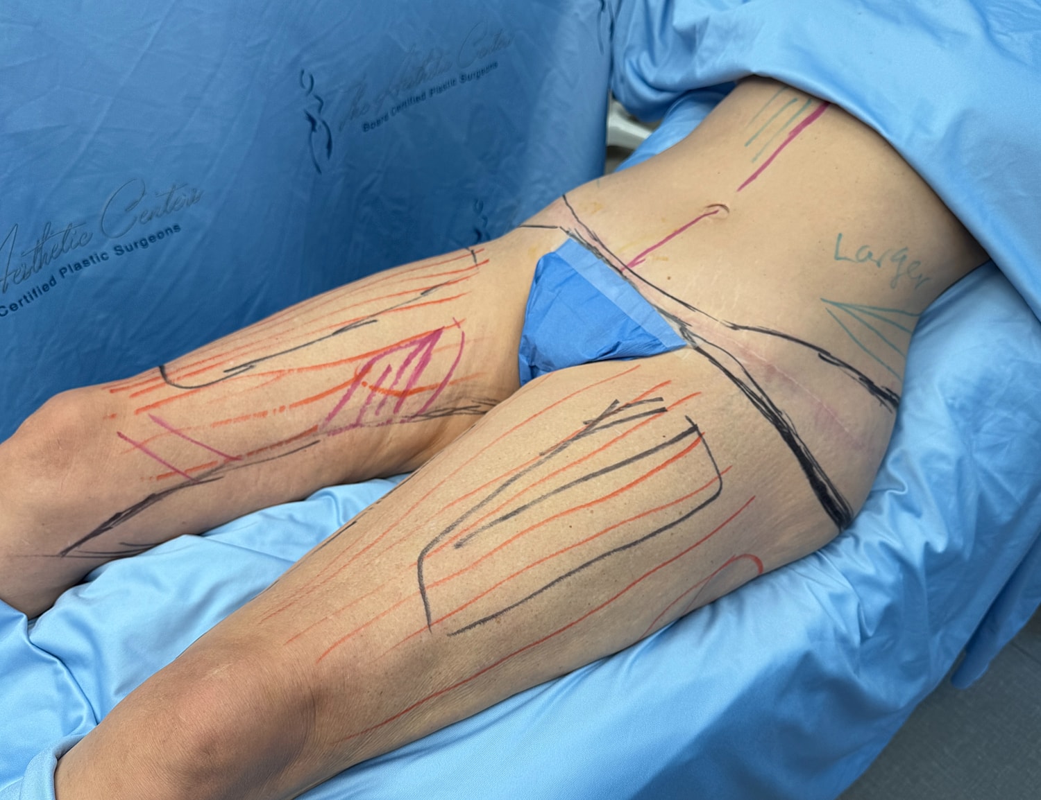 Body marked for plastic surgery procedure.