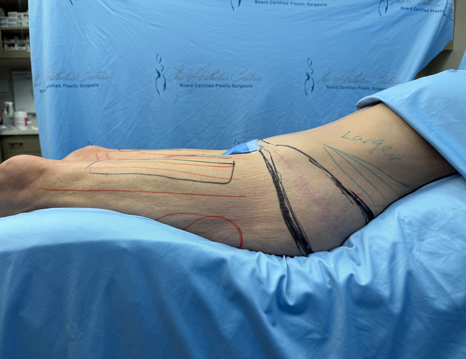 Body markings for a cosmetic procedure preparation.