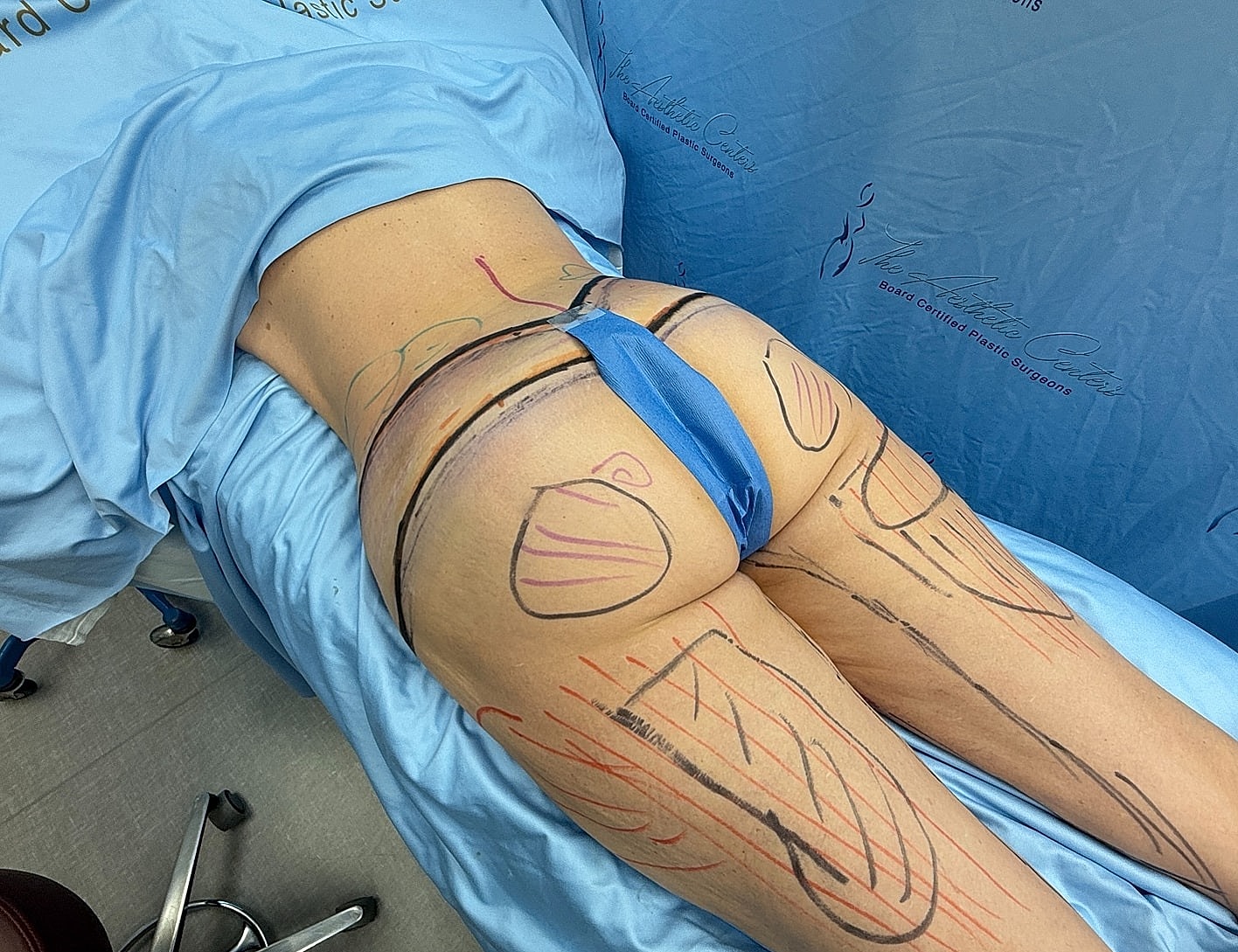 Body marking preparation for cosmetic surgery procedure.