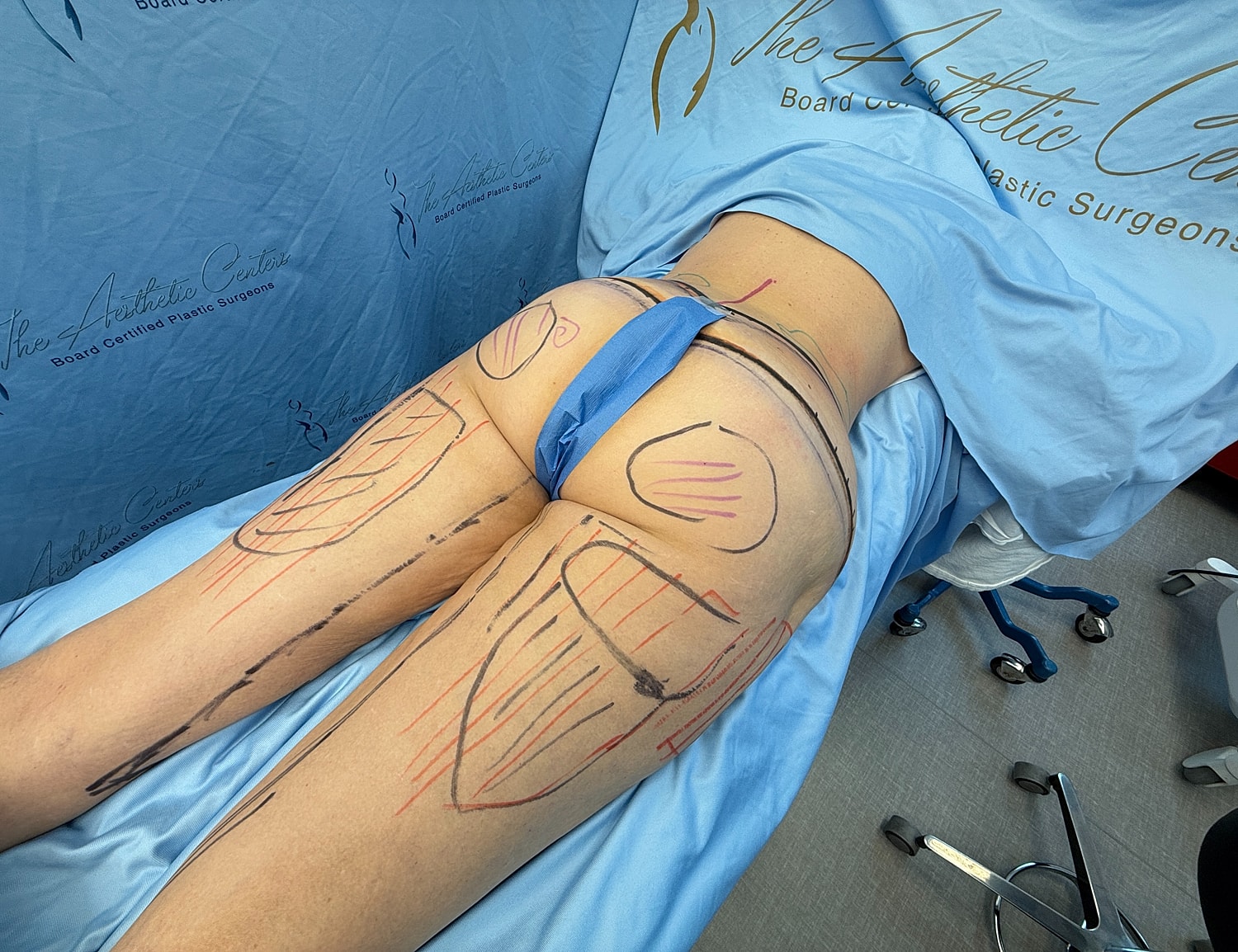 Surgical markings on patient prior to procedure.