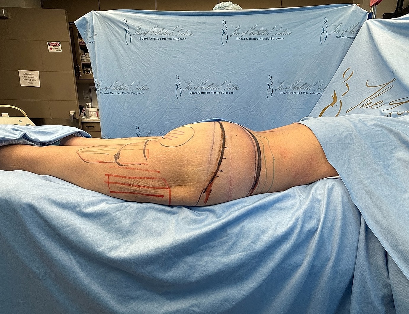 Patient preparation for cosmetic surgery procedure.