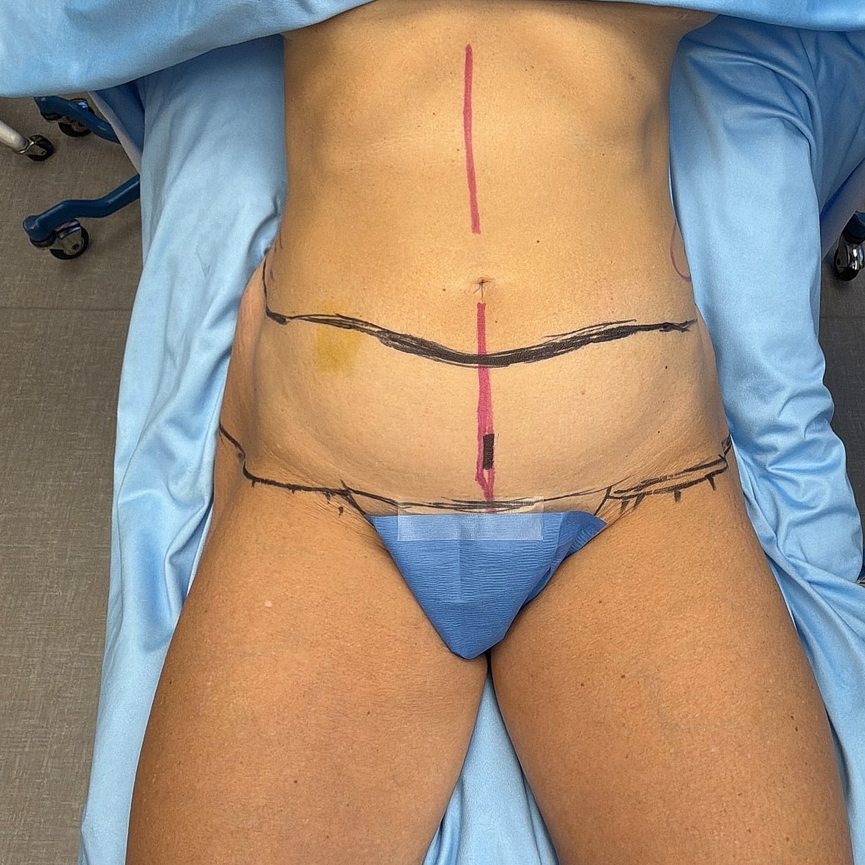 Marked abdomen in a surgical setting.