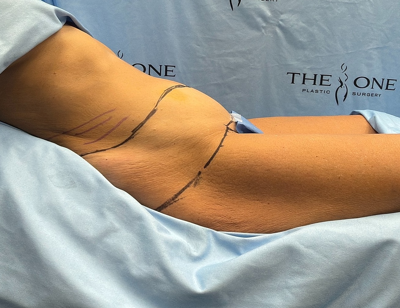 Patient preparation for procedure at plastic surgery clinic.