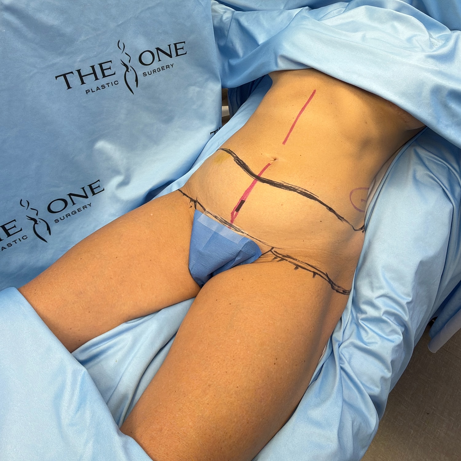 Patient preparation for plastic surgery procedure.