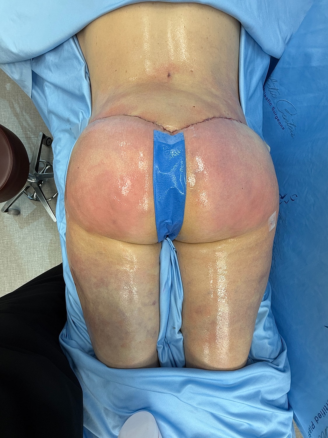 Buttocks after cosmetic procedure, medical setting visible.