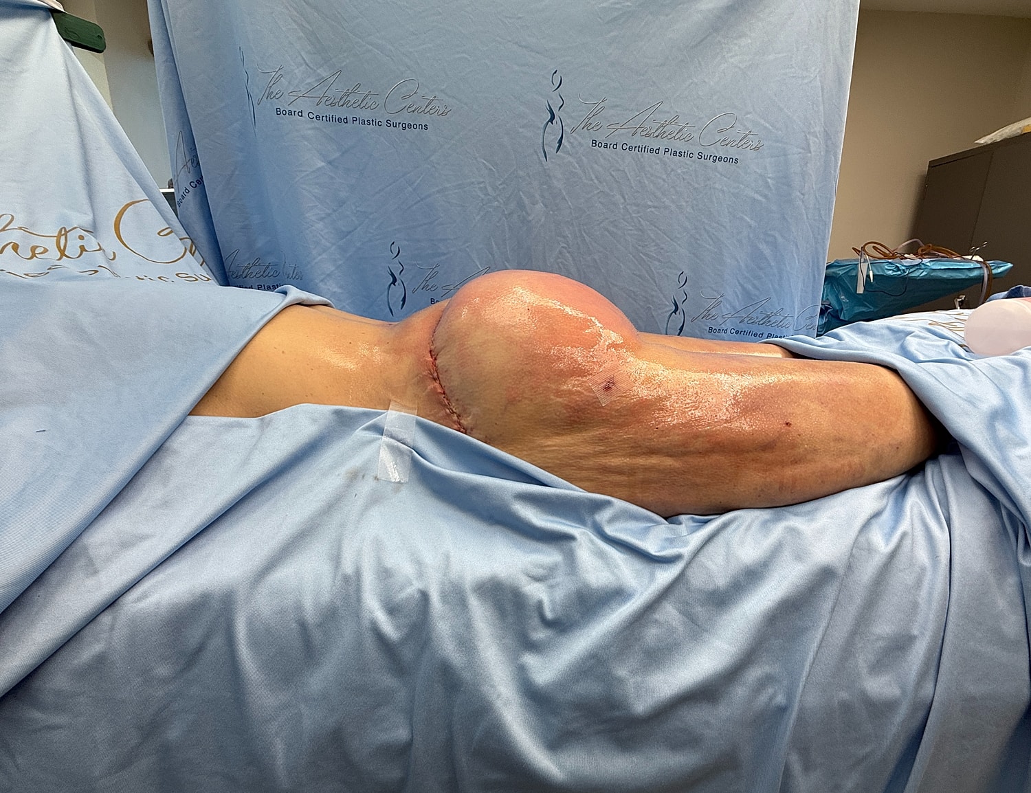 Surgical procedure with bandaged body part visible.