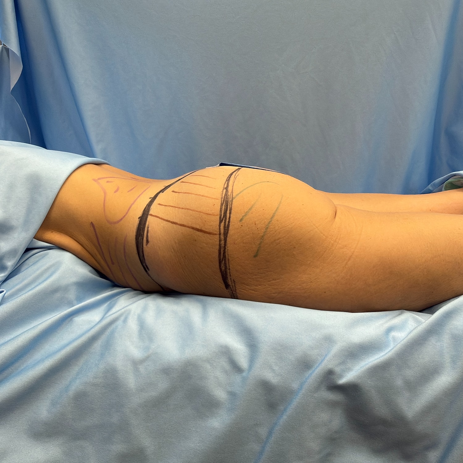 Body markings for medical procedure preparation.