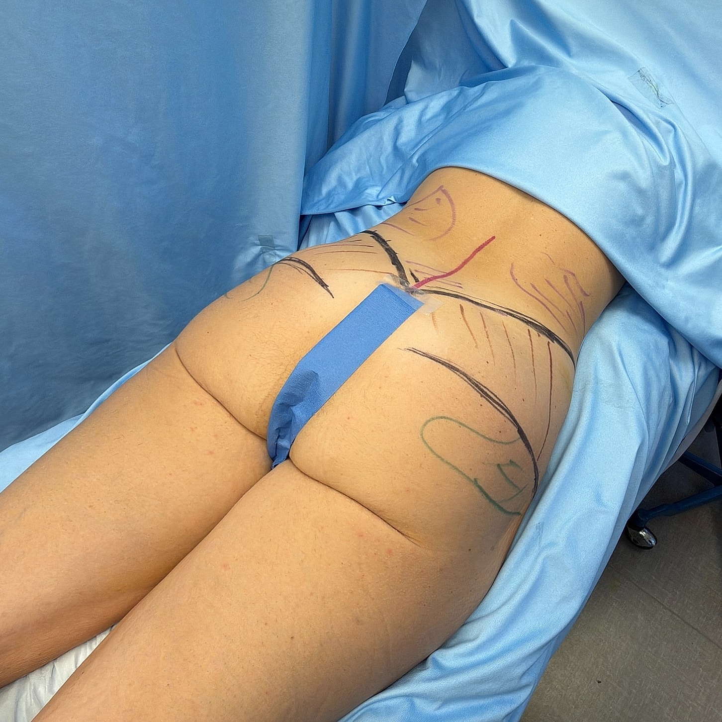 Body marking for a cosmetic procedure preparation.
