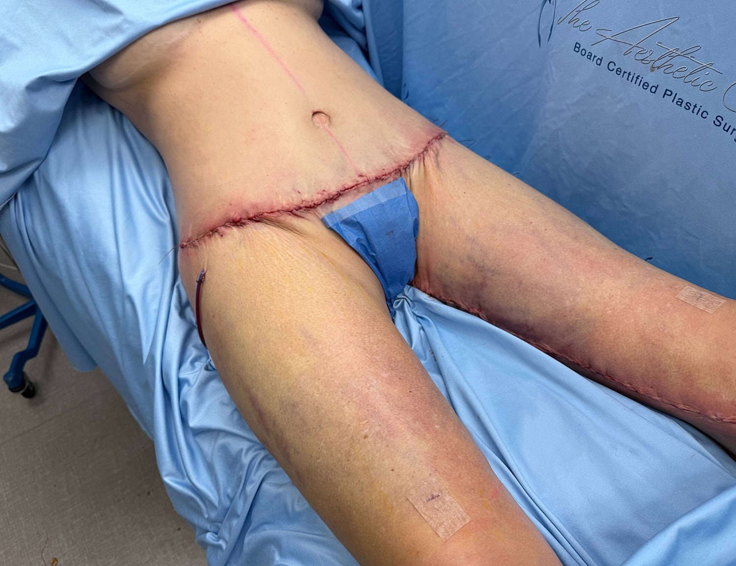 Surgical site after procedure on thigh area.
