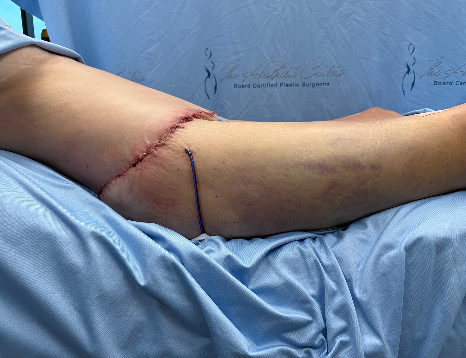 Post-surgery leg with stitches and bruising.