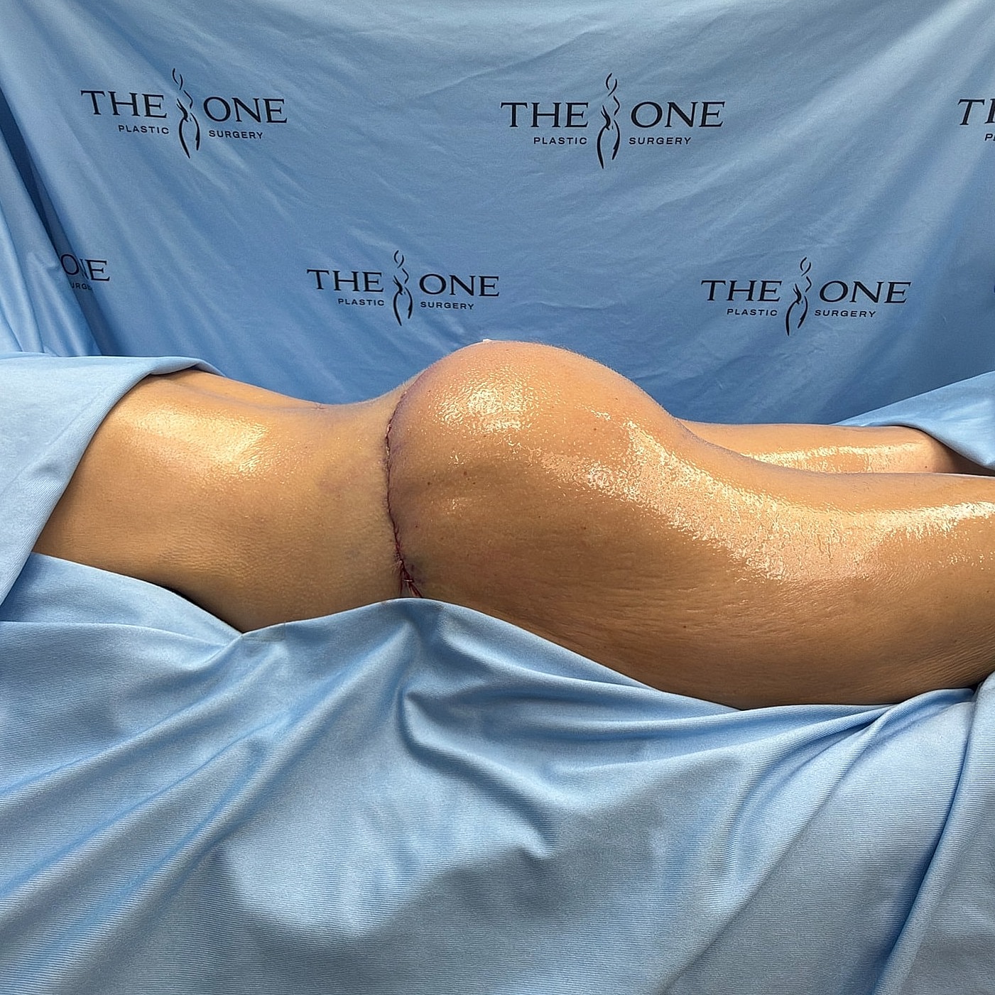 Post-operative view of plastic surgery procedure.