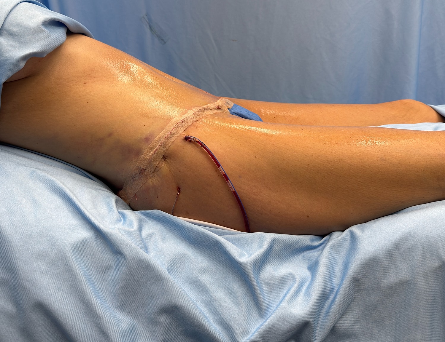 Surgical site on patient's back with catheter.