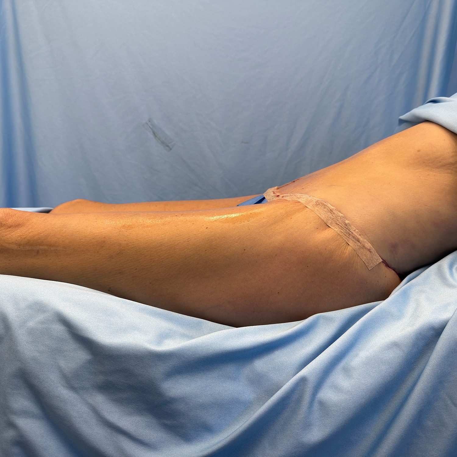Post-surgery recovery with bandage on skin.
