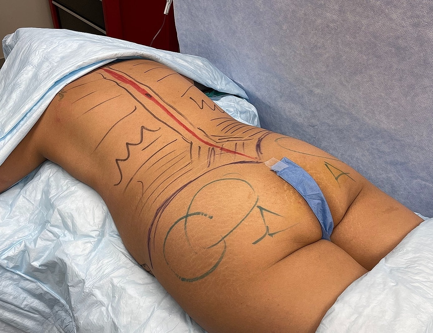 Body marked for surgical procedure preparation