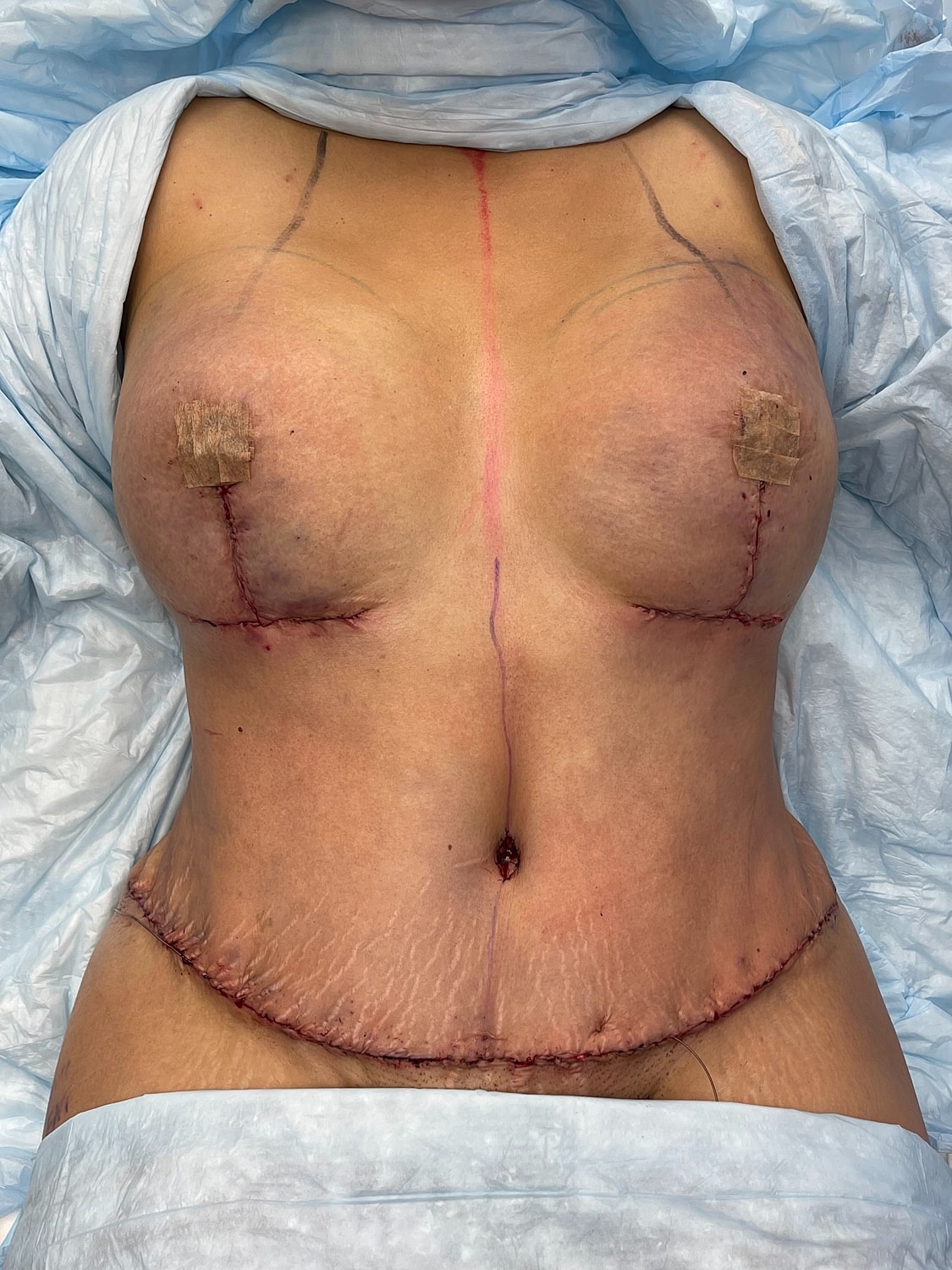Post-operative view of surgical scars and markings.