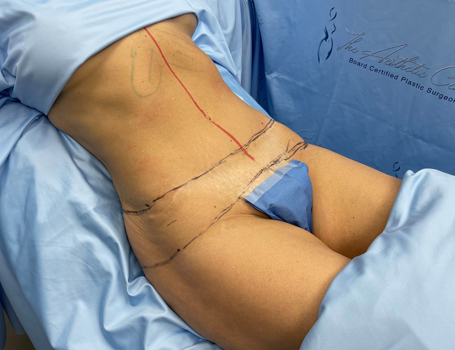 Surgical markings on abdomen before procedure.